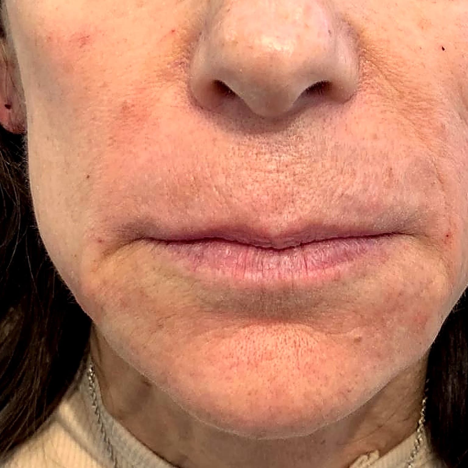 Nasolabial folds and marionette lines, after treatment