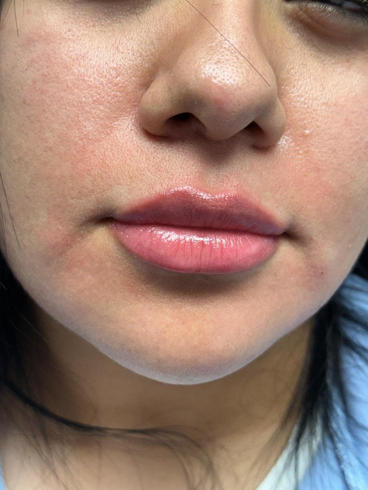 Dermal Fillers