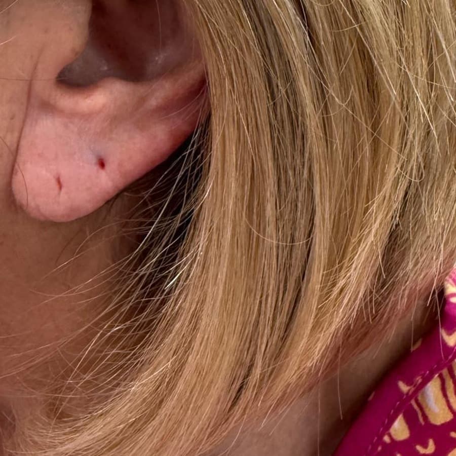 Earlobe, thinned and creased