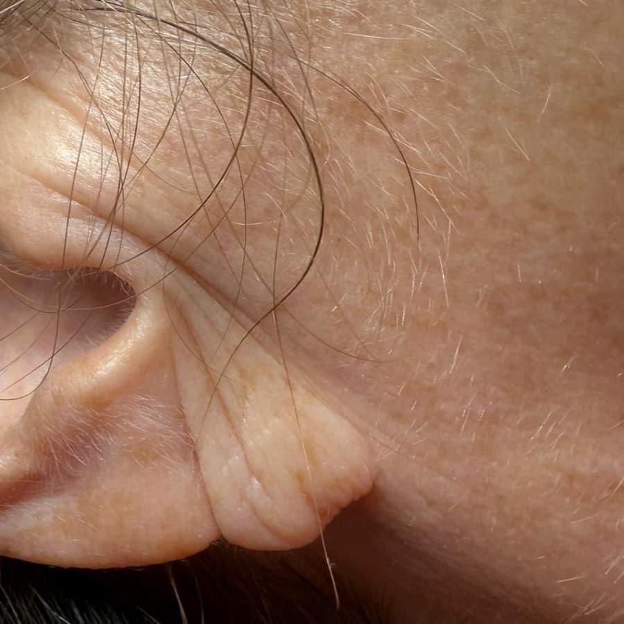Earlobe, deep horizontal crease