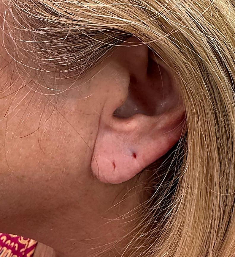 Stretched piercing, thinned lobe