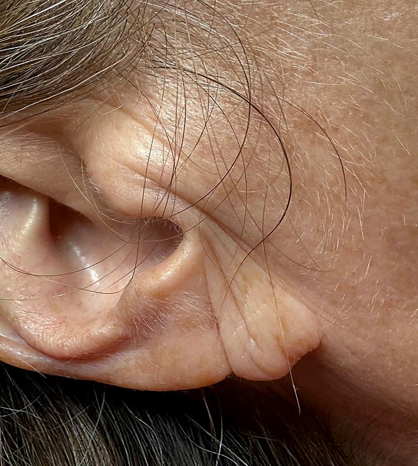 Deep crease across the lobe